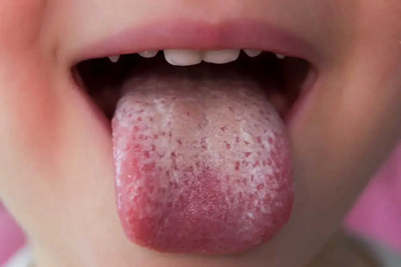 Grzybica jamy ustnej: Leczenie farmakologiczne i domowe sposoby
