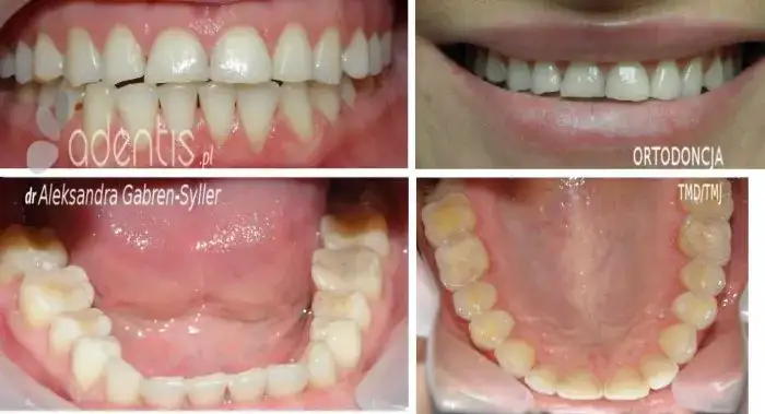 Starte zęby: Jak skutecznie odbudować? Metody, koszty, profilaktyka.