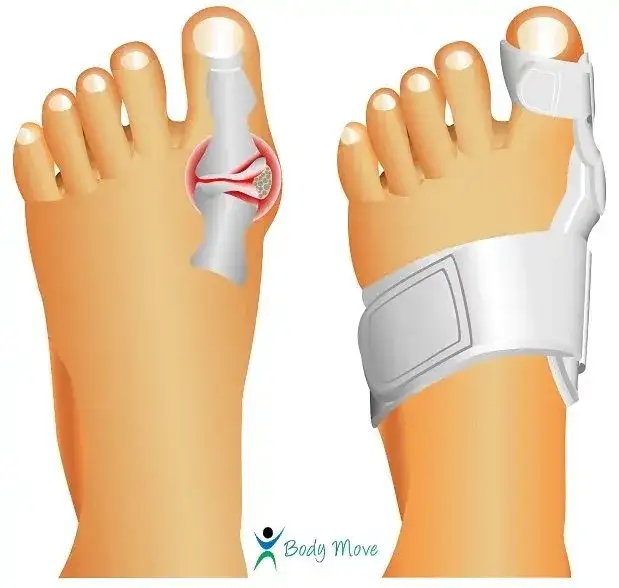 Co na haluksy do butów? Skuteczne sposoby na ból i komfort