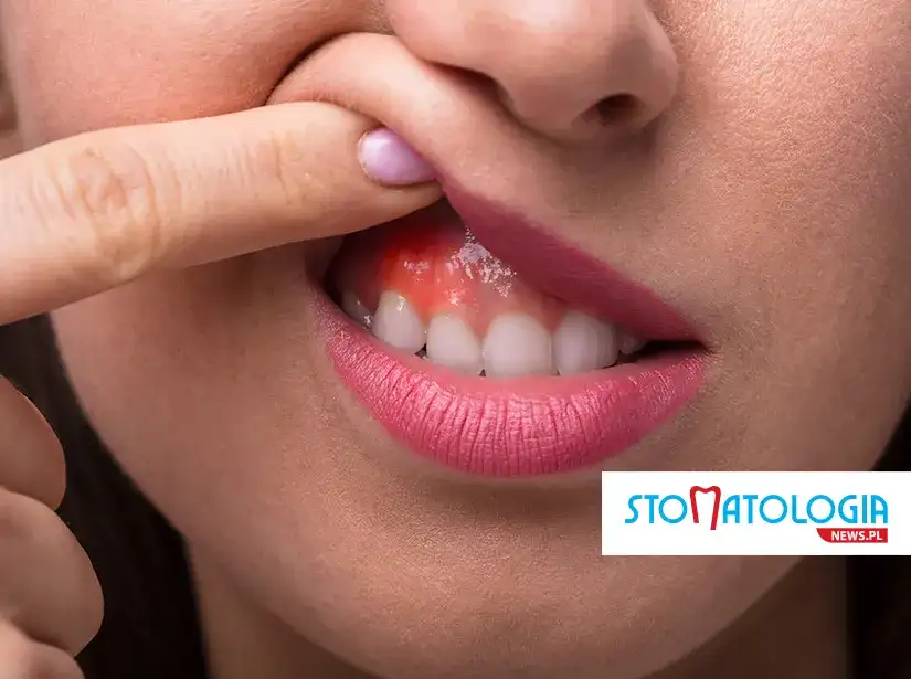 Co zrobić na spuchnięte dziąsło? Szybka ulga i porady eksperta.
