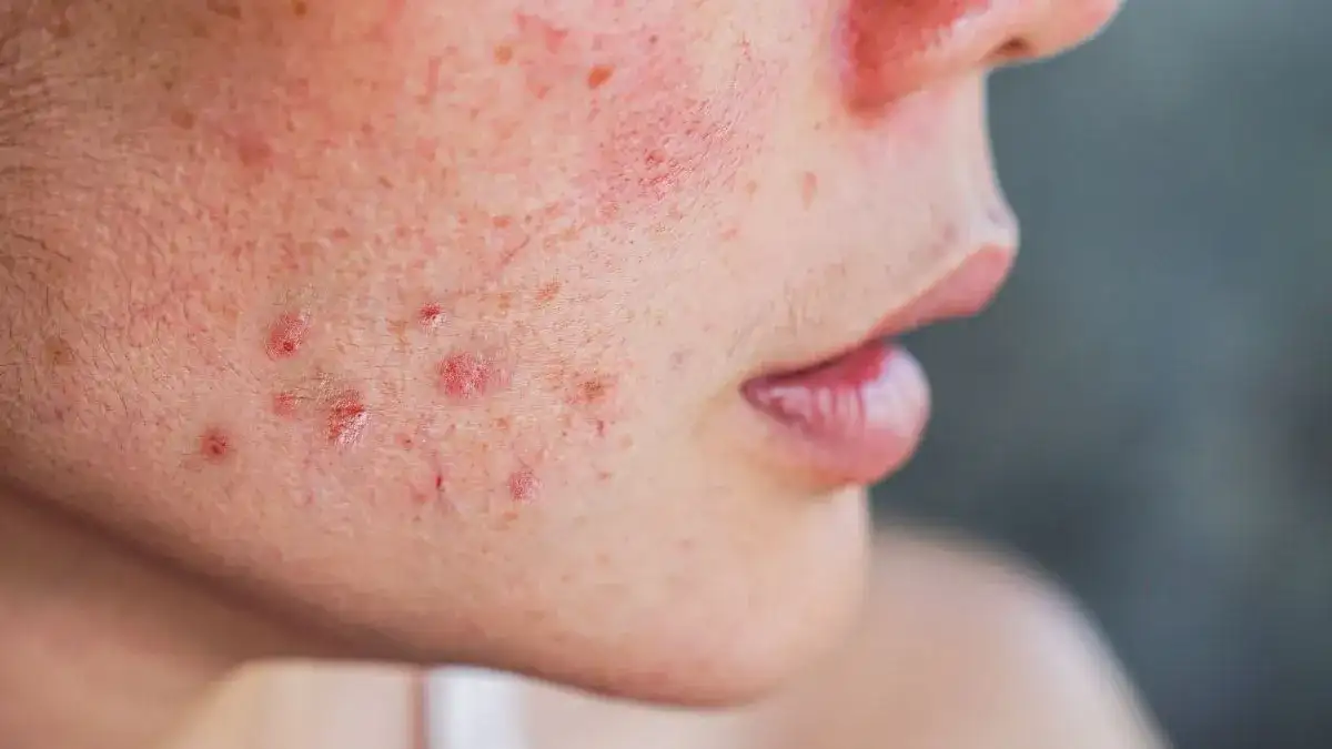 Jakie kosmetyki wybrać na kaszkę na twarzy? Skuteczne sposoby i porady dermatologiczne