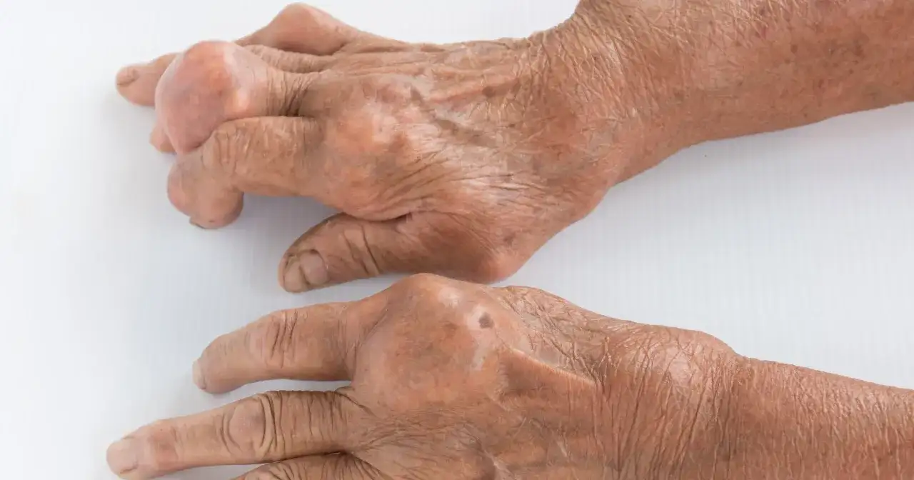 Jakie leki na podagrę pomogą w walce z bólem i stanem zapalnym