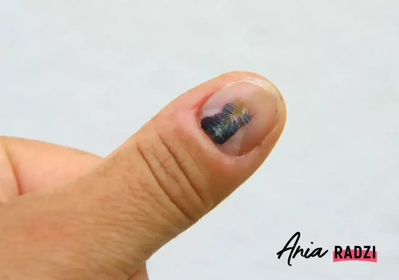 Stłuczony paznokieć: jak leczyć? Kiedy do lekarza, a kiedy domowe sposoby?