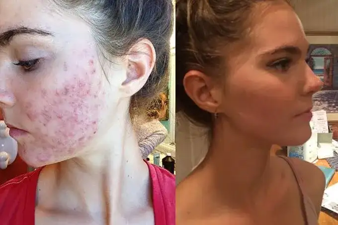 Jak pozbyć się pryszczy? Przewodnik eksperta: dieta, pielęgnacja