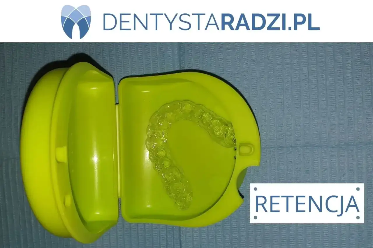 Cena nakładki retencyjnej po aparacie: Ile kosztuje i którą wybrać?