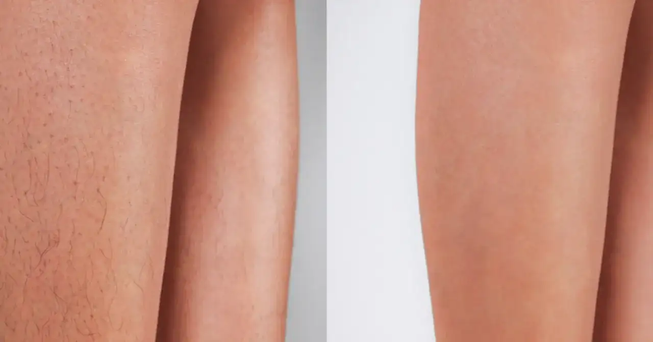 Depilacja laserowa: na ile lat gładka skóra? Co musisz wiedzieć