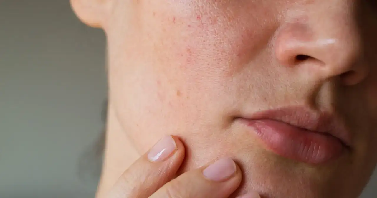 Zbliżenie na skórę twarzy z widocznymi zaczerwienieniami i niedoskonałościami, palec wskazujący dotyka policzka.