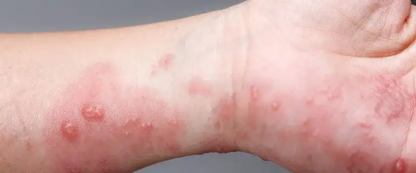 Świerzb objawy - rozpoznaj pierwsze oznaki choroby u siebie i bliskich