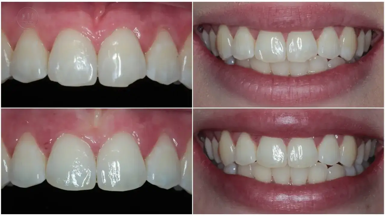 Ile licówek? Odkryj idealną liczbę dla Twojego uśmiechu!