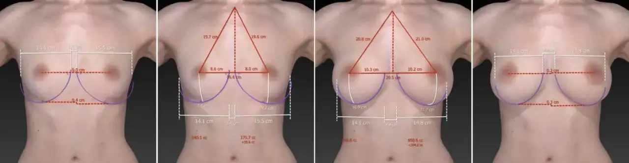 Gdzie najlepiej zrobić operację powiększenia biustu? Ranking klinik