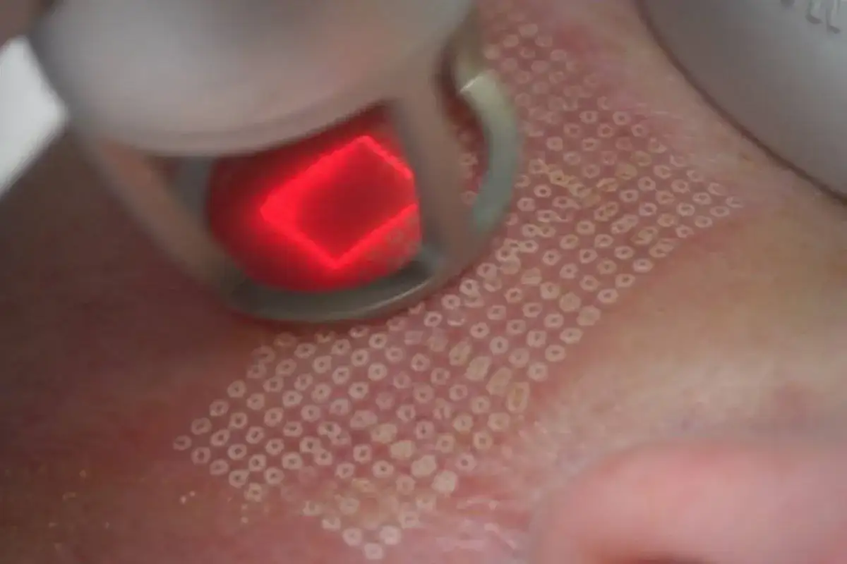 Zabieg laserem frakcyjnym: czy laser frakcyjny jest bezpieczny? Skóra po zabiegu z widocznymi mikrouszkodzeniami.