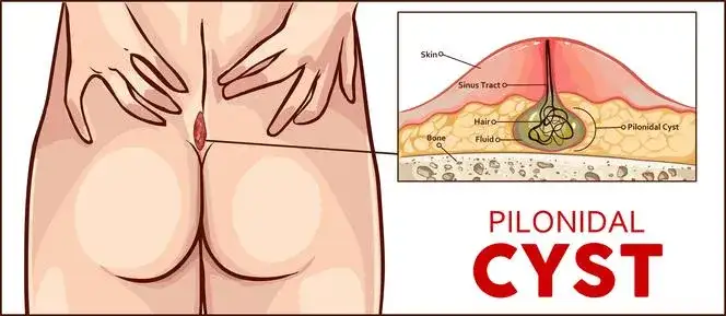 Zapalenie kości ogonowej objawy: jak rozpoznać ból i dyskomfort