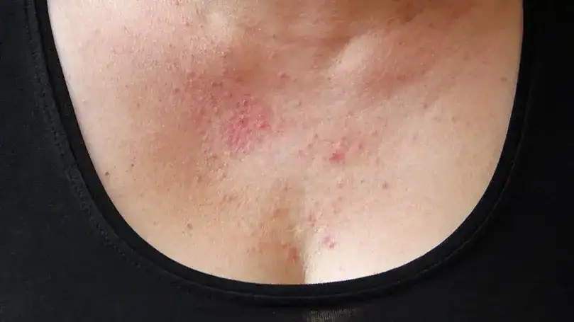 Überdosierung von Vitamin B12: Risiken, Nebenwirkungen und Sicherheit