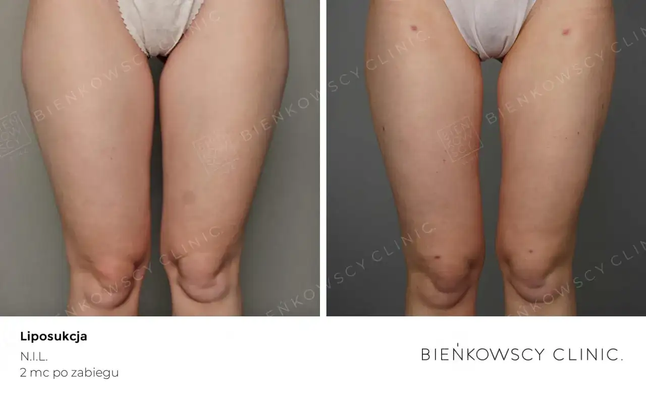 Liposukcja: modelowanie sylwetki czy odchudzanie? Sprawdź, co musisz wiedzieć