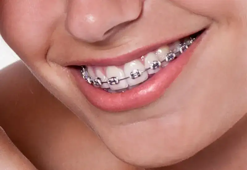 Jak wygląda zakładanie aparatu na zęby – co musisz wiedzieć przed wizytą