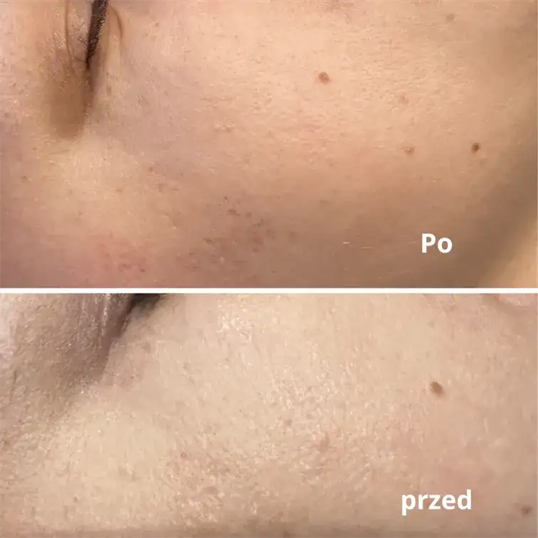 Kiedy makijaż po laserze frakcyjnym? Bezpieczne terminy i zasady