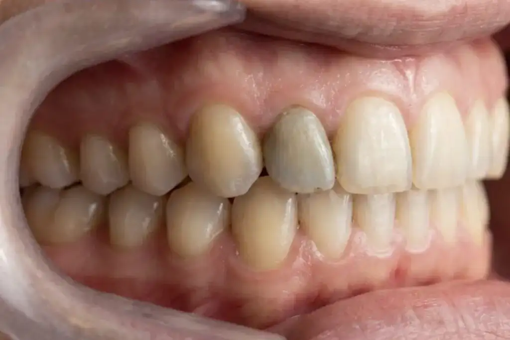 Martwy ząb: Ile lat wytrzyma? Fakty i mity o jego żywotności