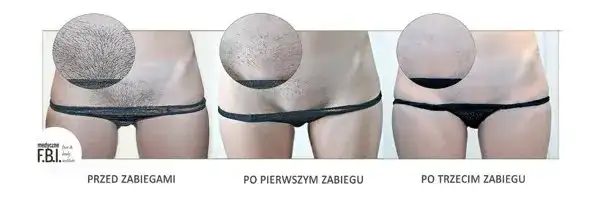 Depilacja laserowa bikini: Ile zabiegów dla gładkiej skóry na lata?