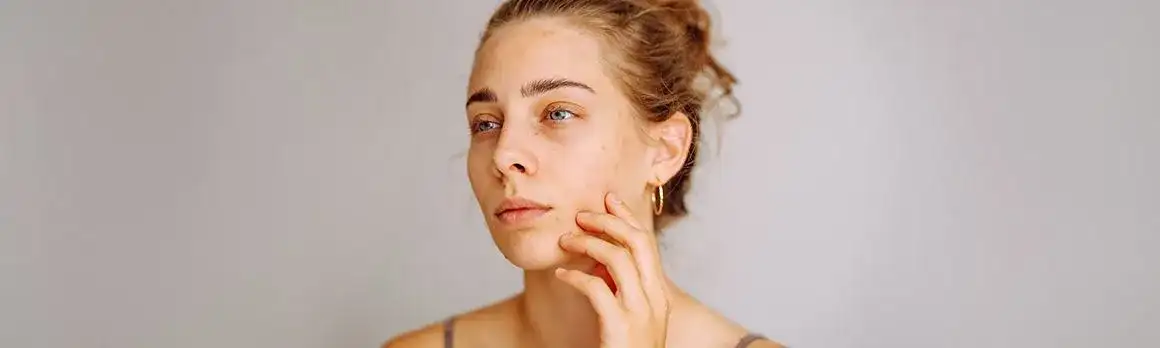 Jak przestać wyciskać pryszcze? Koniec z bliznami i przebarwieniami.