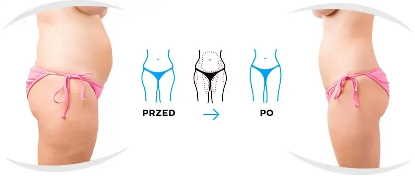 Liposukcja: Czy jest bezpieczna? Dowiedz się, zanim podejmiesz decyzję