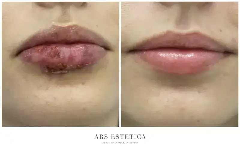 Ulga po powiększaniu ust: Ból, obrzęk? Ekspert radzi, co robić.