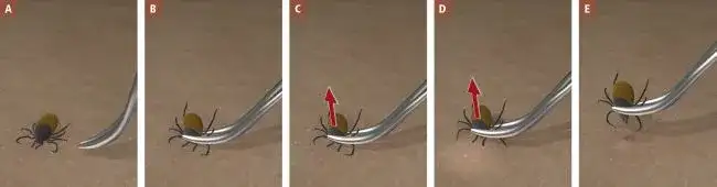 Kleszcz? Jak wyjąć bezpiecznie i co robić po ukąszeniu