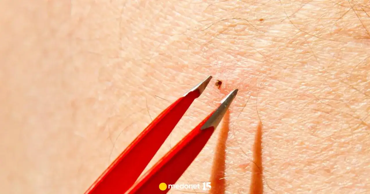 Mały kleszcz? Jak usunąć nimfę: Bezpiecznie, szybko, bez błędów!