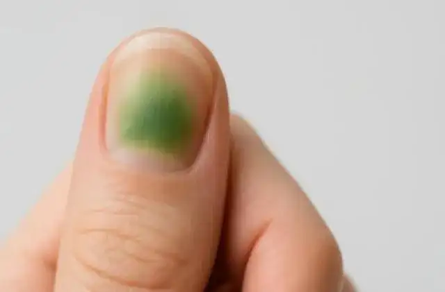 Zielona plama na paznokciu: leczenie, przyczyny i jak odróżnić od grzybicy