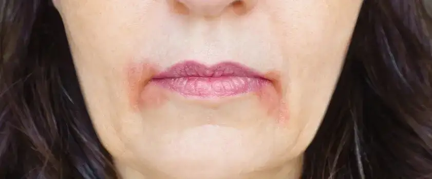 Zapalenie Wokół Ust: Zrozum Dermatozę Okołoustną, Zdjęcia i Leczenie Zapalenia Skóry