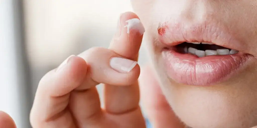 Jak leczyć ospę w jamie ustnej i złagodzić ból skutecznie