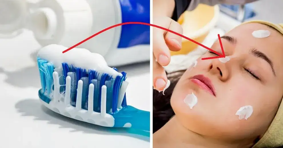 Czy pasta do zębów wysusza pryszcze? Prawda i ryzyko dla skóry