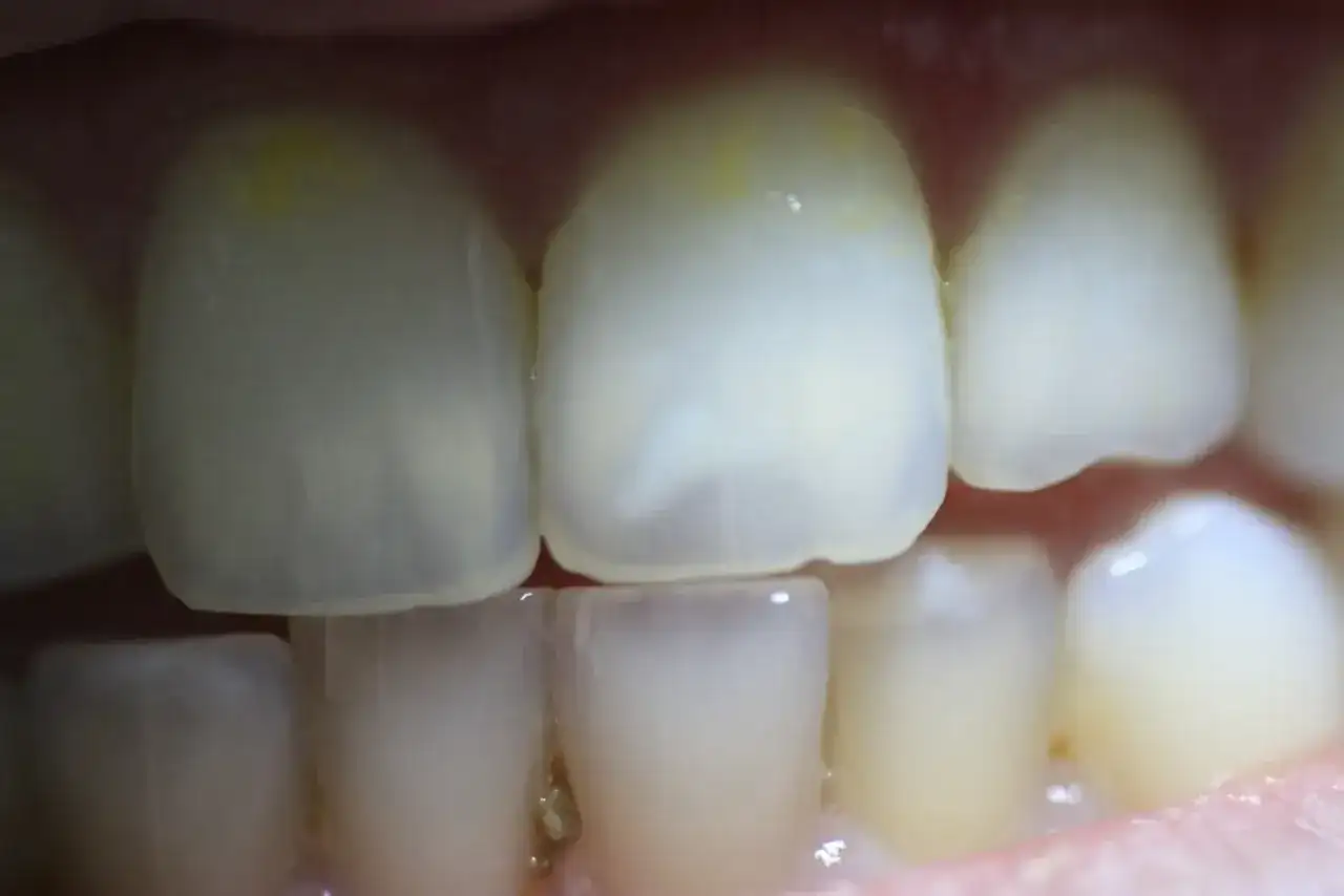 Jak usunąć przebarwienia z zębów? Kompleksowy przewodnik i koszty