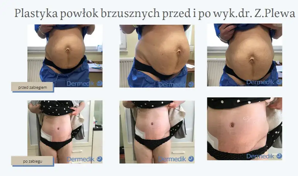Liposukcja: Co to jest i czy to rozwiązanie dla Ciebie?