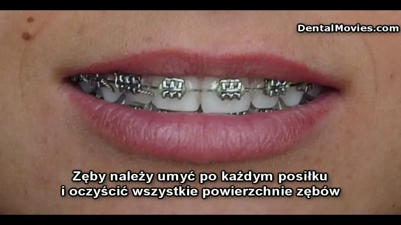 Ile trwa zakładanie aparatu i czy boli? Przewodnik ortodonty