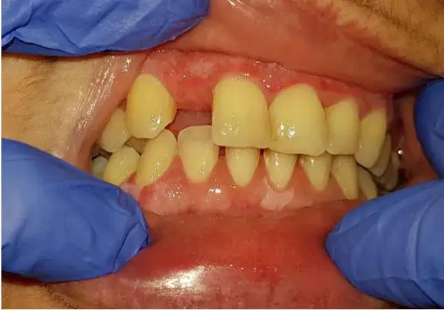 Liszaj w jamie ustnej? Poznaj skuteczne leczenie i odzyskaj komfort