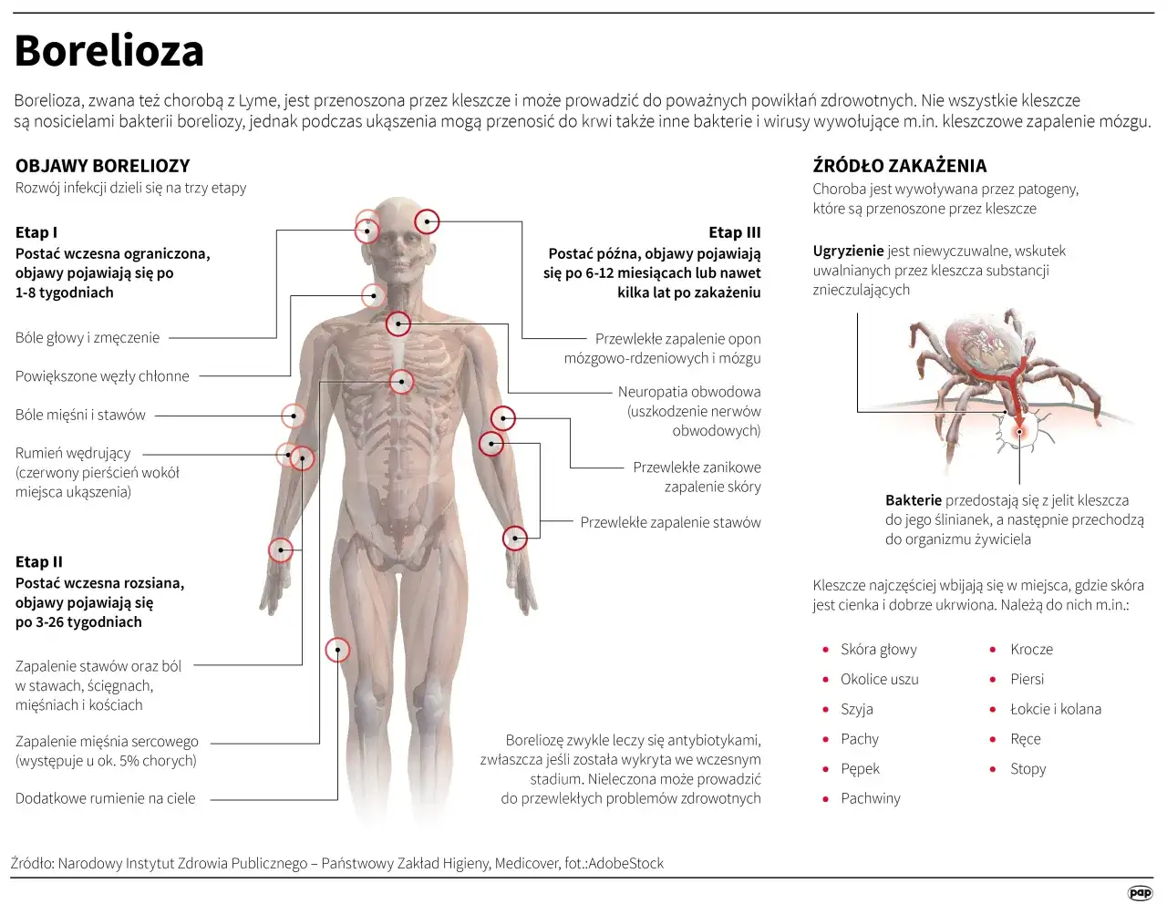 Borelioza objawy po latach - jak nieleczona choroba wpływa na zdrowie?
