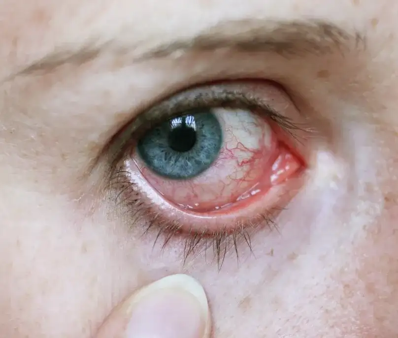 Fibromyalgie Symptome Augen: Unerwartete Beschwerden und Lösungen