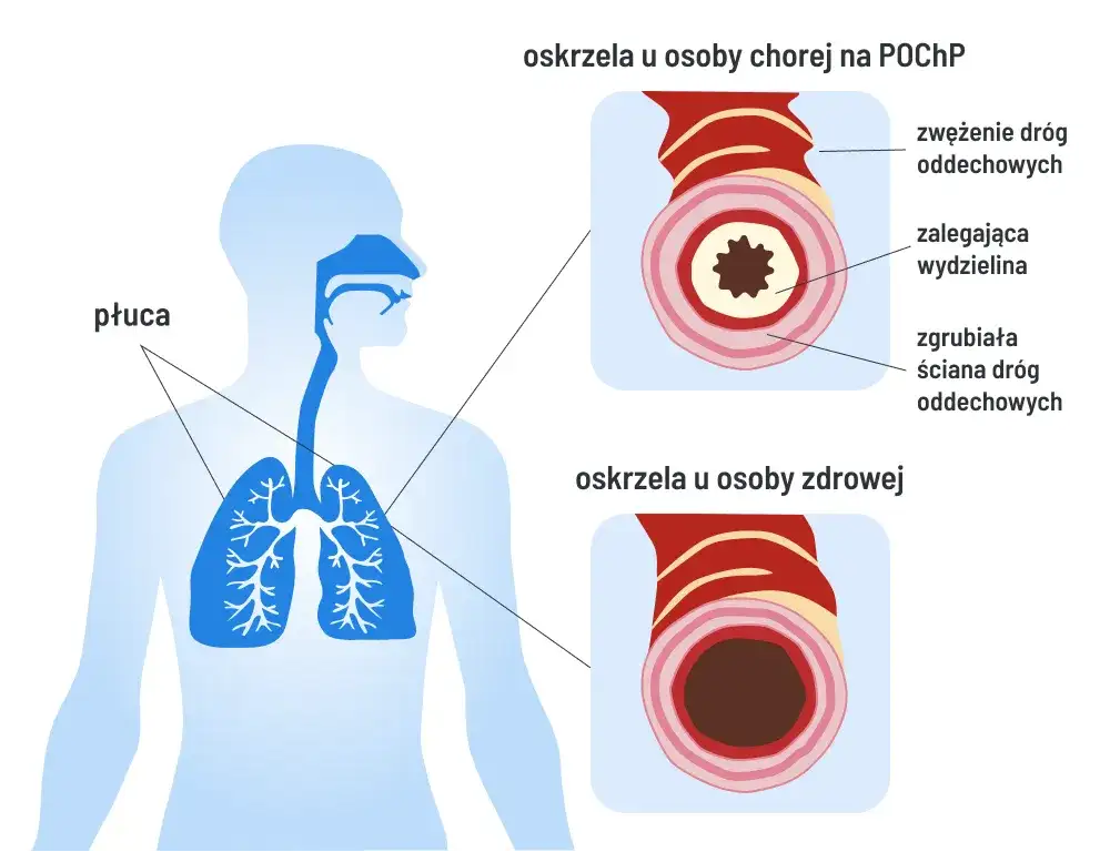 Czy POChP kwalifikuje do renty? Sprawdź, co musisz wiedzieć