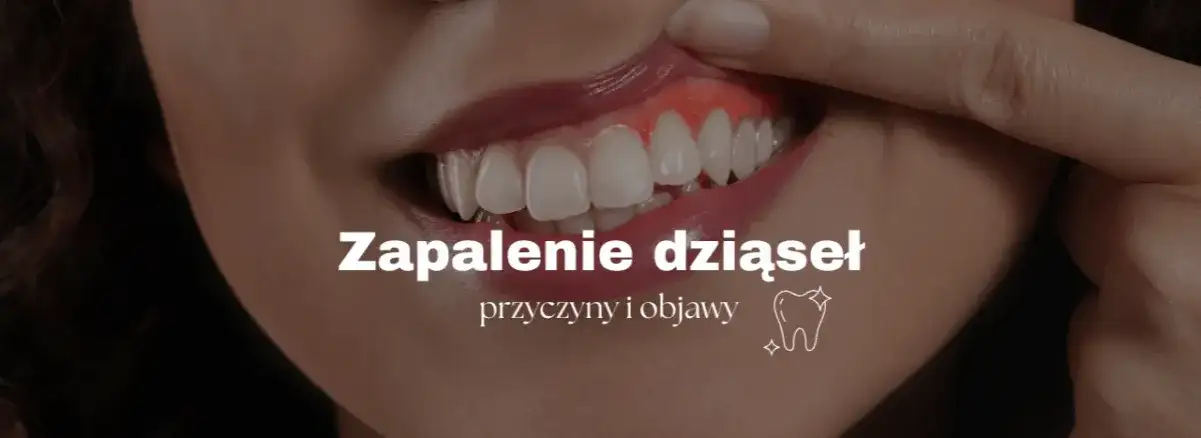 Zapalenie dziąseł: Rozpoznaj objawy i uniknij utraty zębów!