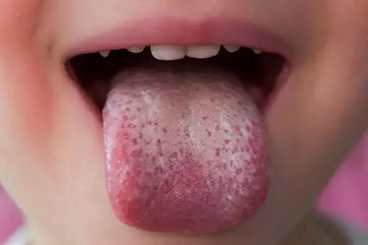 Grzybica jamy ustnej: objawy, zdjęcia, leczenie jak ją rozpoznać?
