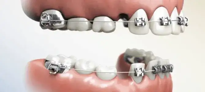 Aparat na zęby: Kto zakłada i jak wybrać najlepszego ortodontę?