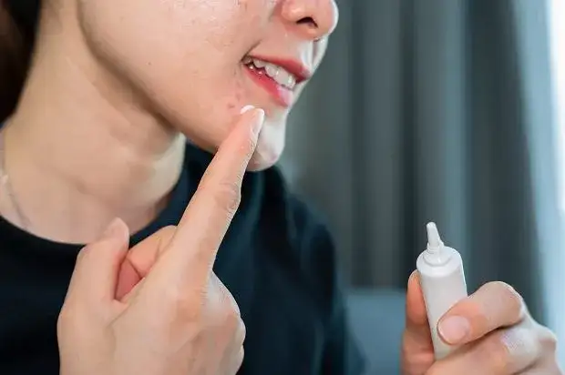 Pasta do zębów na pryszcze? Dermatolog ostrzega! Poznaj prawdę