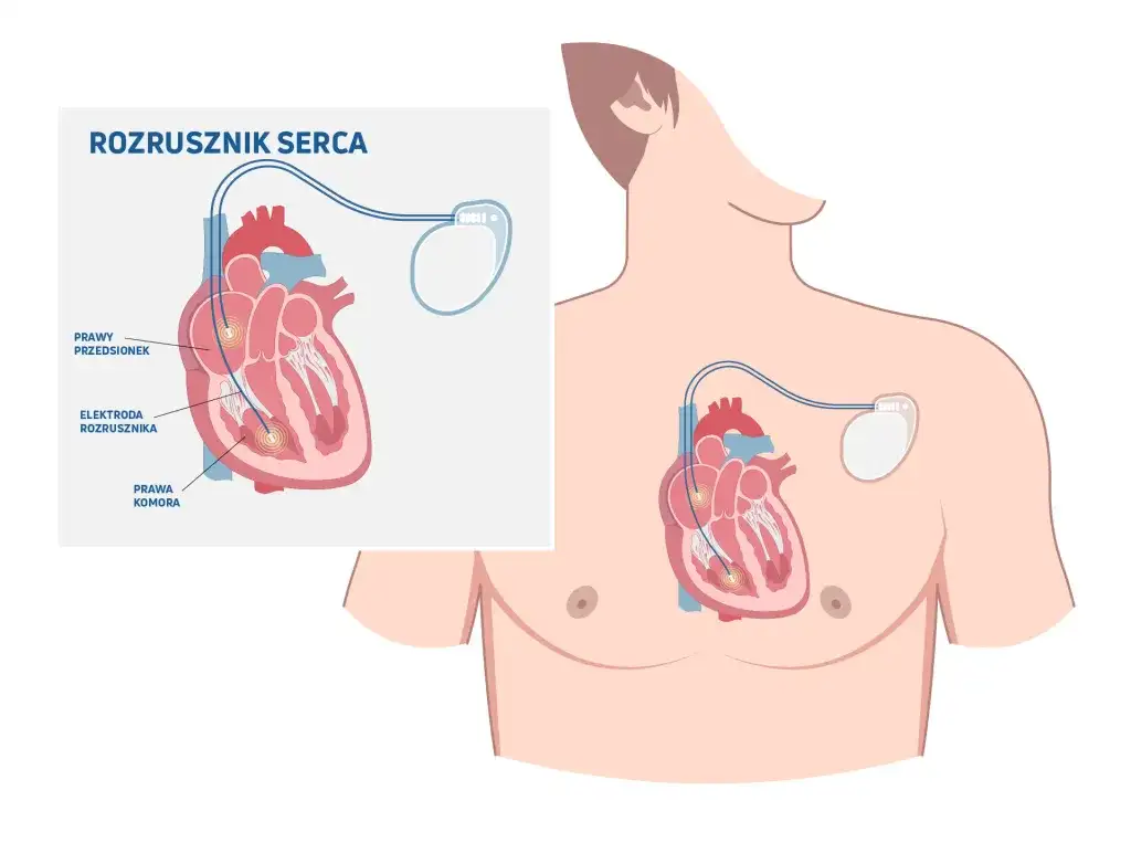 Skutki uboczne po wszczepieniu rozrusznika serca – najważniejsze informacje i objawy.