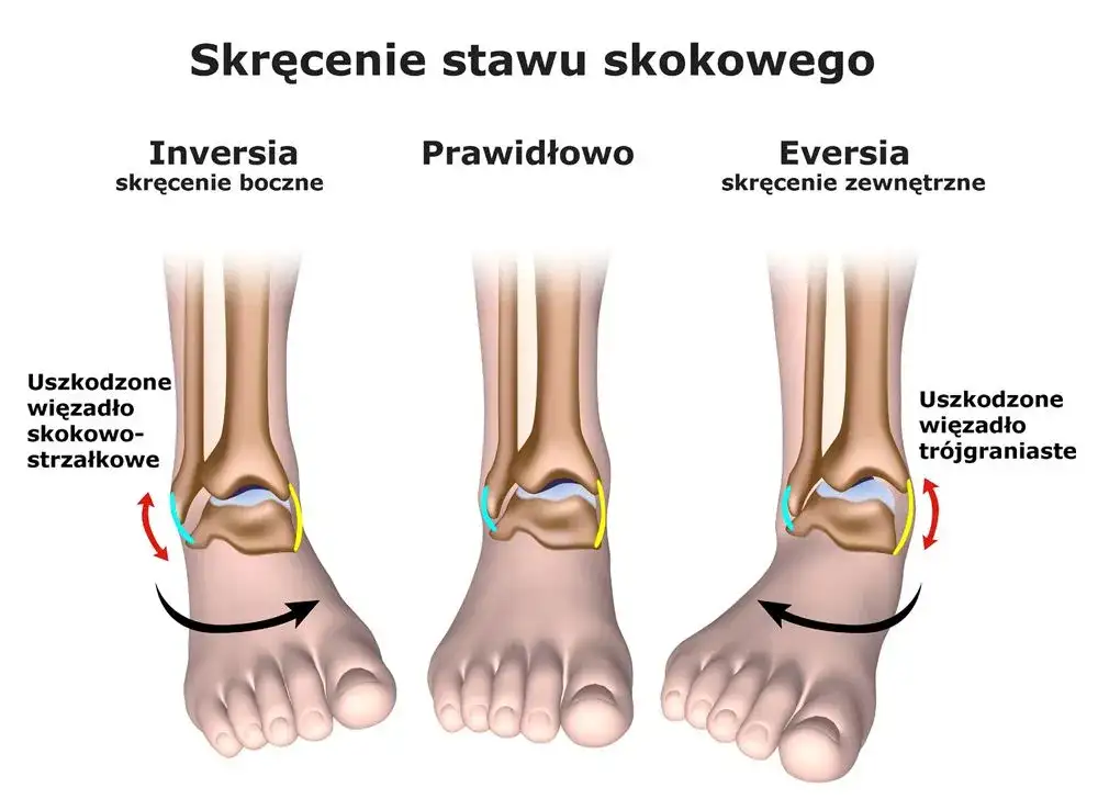 Objawy skręcenia: jak rozpoznać poważne kontuzje stawów