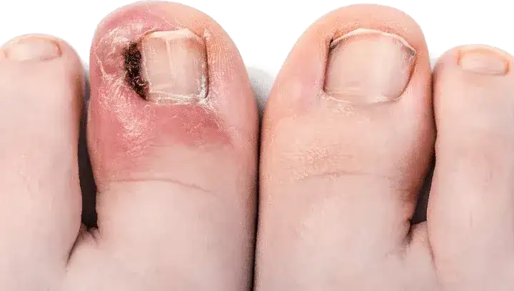 Wrastający paznokieć: Jak leczyć w domu i kiedy do podologa?