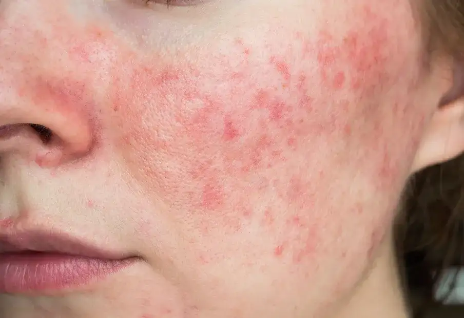 Trądzik różowaty przyczyny: Co wywołuje tę uciążliwą chorobę?