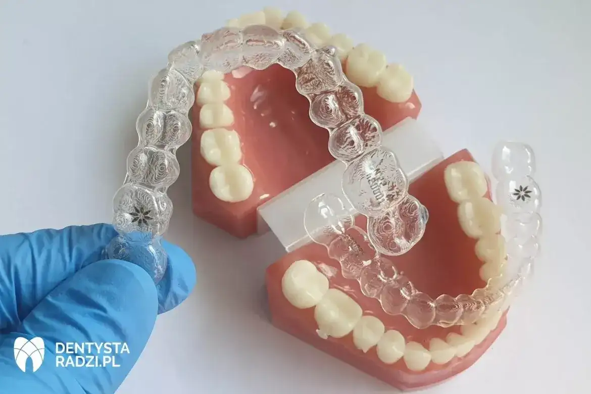 Aparat na dolne zęby: Ile kosztuje i czy warto leczyć tylko jeden łuk?