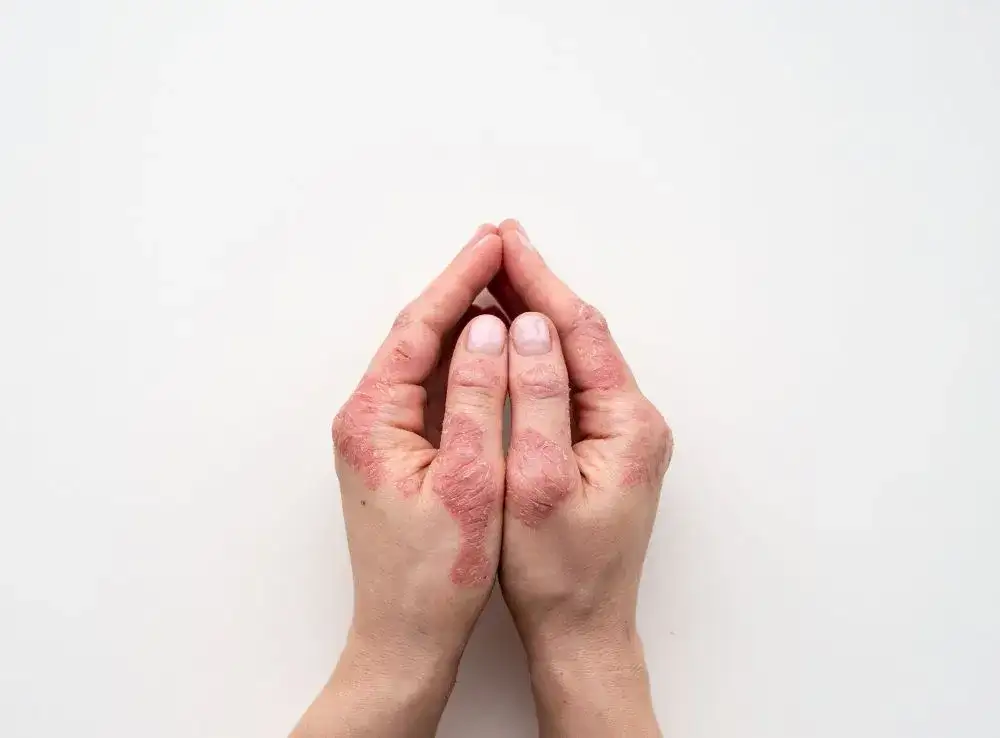 Łuszczyca dłoni: Jak rozpoznać 5 kluczowych objawów?