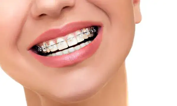 Czy zakładanie aparatu na zęby boli? Prawda o bólu i dyskomforcie