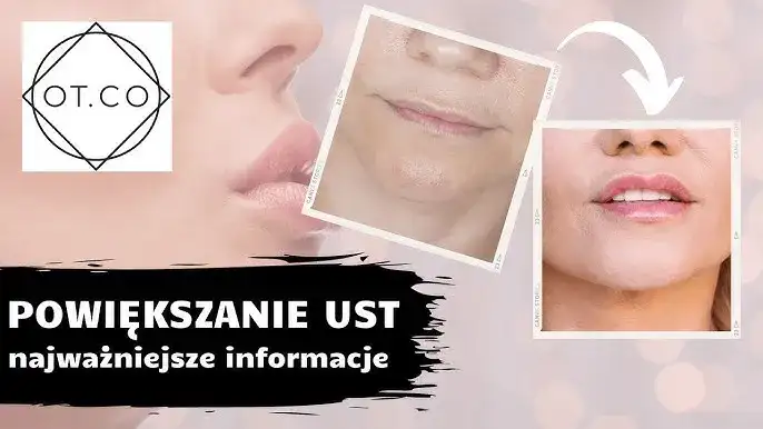 Powiększanie ust: Bezpieczeństwo, efekty, koszty wszystko, co musisz wiedzieć